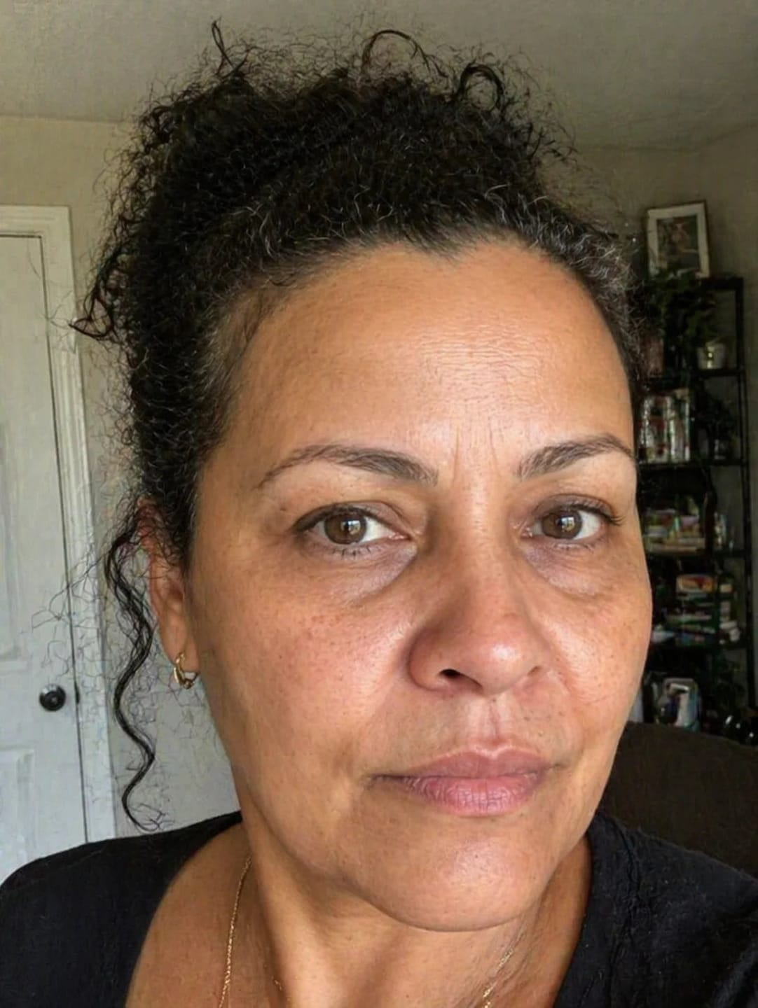 Customer photo review of ELYVIA Micro-Infusion System™