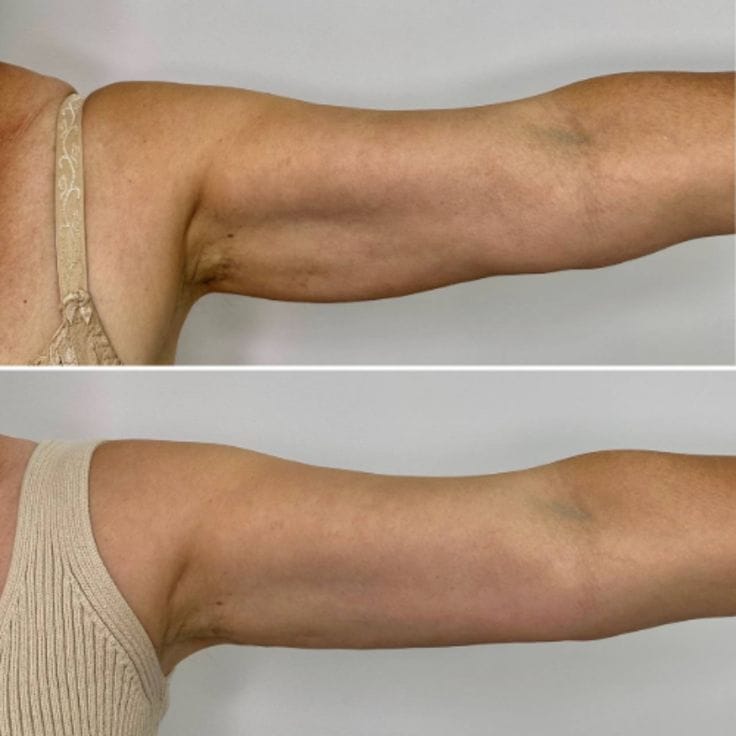 Customer photo review of Drainant Lymphatique BelGlow — Complexe Lympha-4
