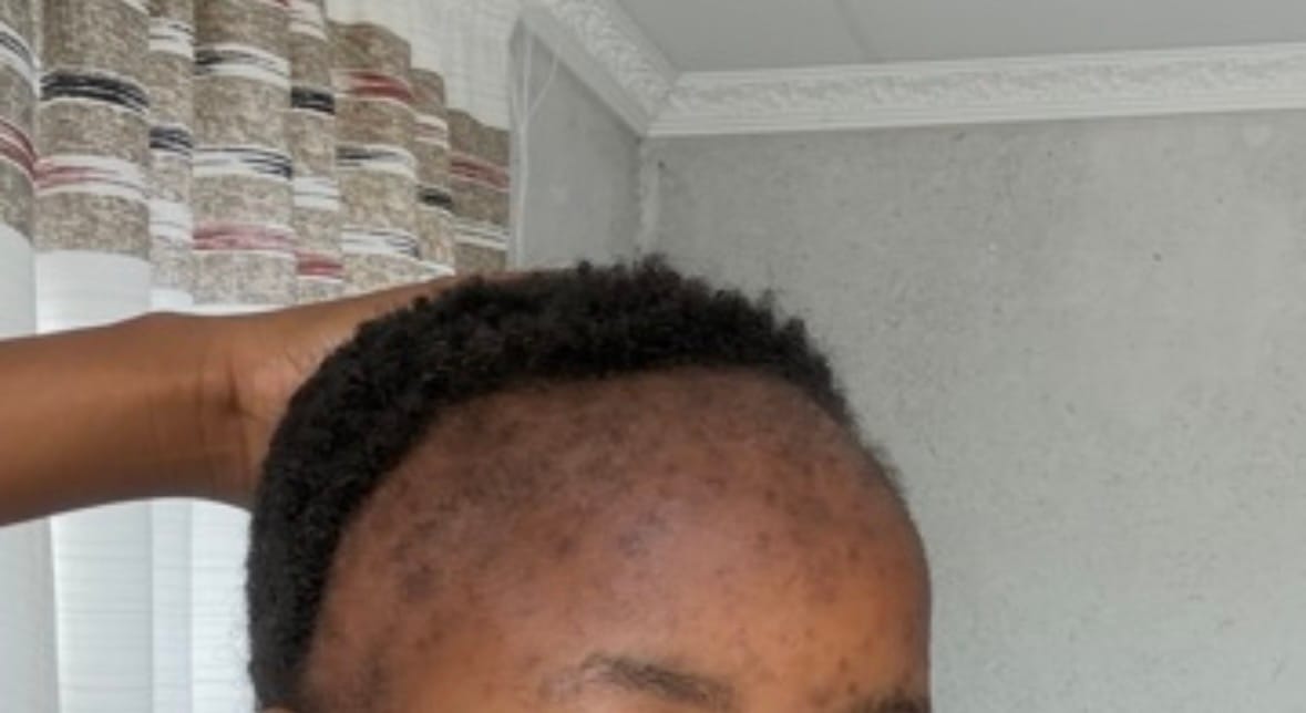 Customer photo review of Derma Roller 0.5mm