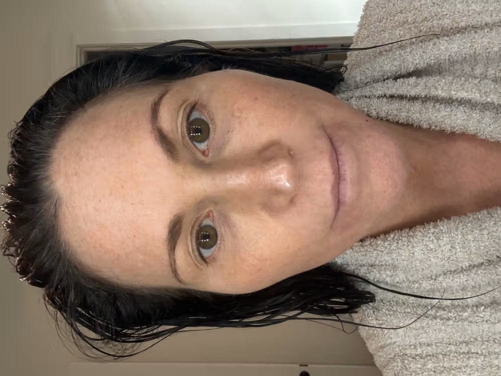 Customer photo review of ELYVIA Micro-Infusion System™
