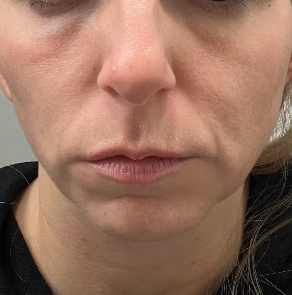 Customer photo review of ELYVIA Micro-Infusion System™
