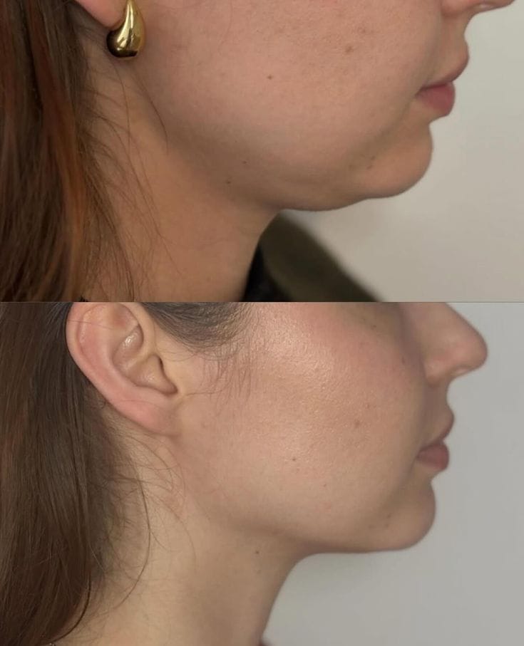 Customer photo review of Drainant Lymphatique BelGlow — Complexe Lympha-4