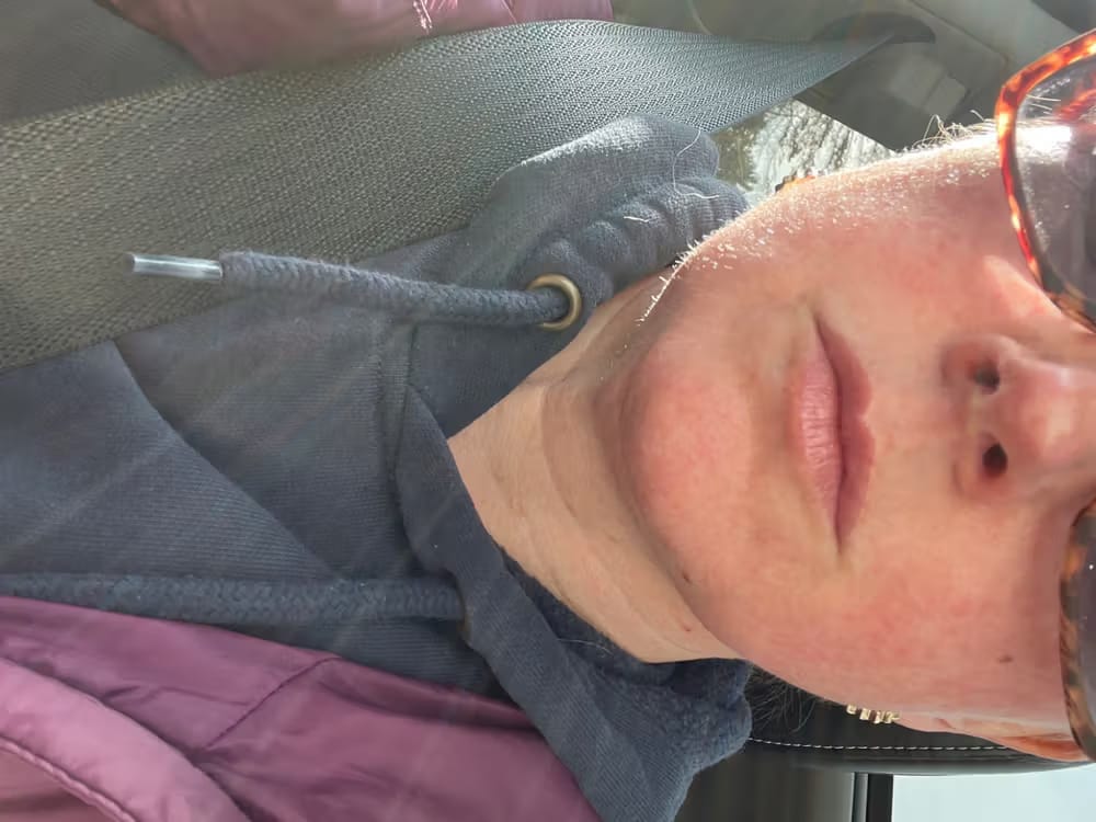 Customer photo review of ELYVIA Micro-Infusion System™
