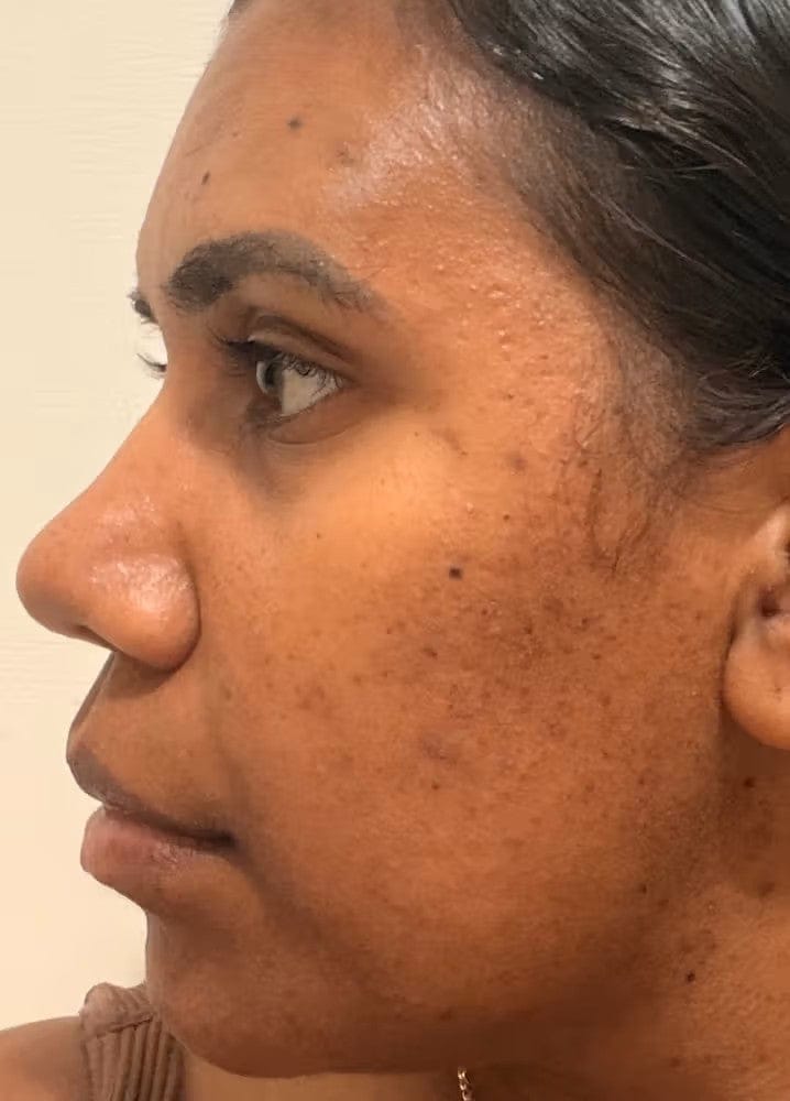 Customer photo review of ELYVIA Micro-Infusion System™