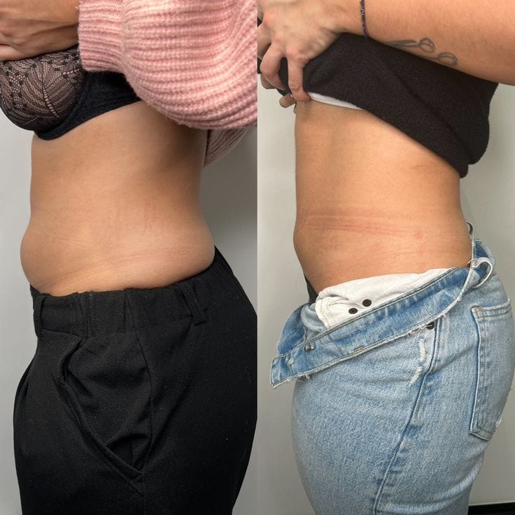 Customer photo review of Drainant Lymphatique BelGlow — Complexe Lympha-4