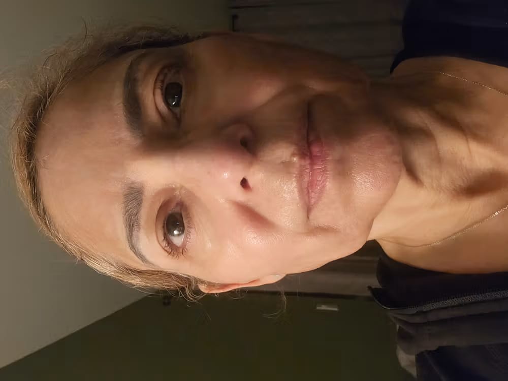 Customer photo review of ELYVIA Micro-Infusion System™