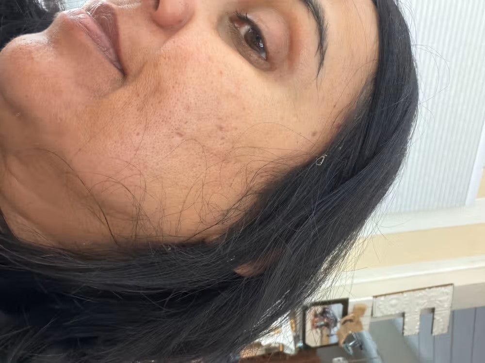 Customer photo review of ELYVIA Micro-Infusion System™