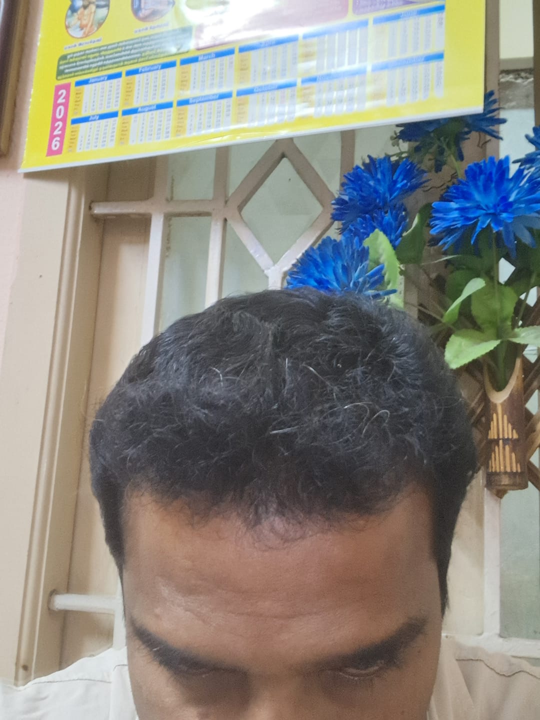 Customer photo review of Advance Hair Growth Serum 2.0 (30ml)