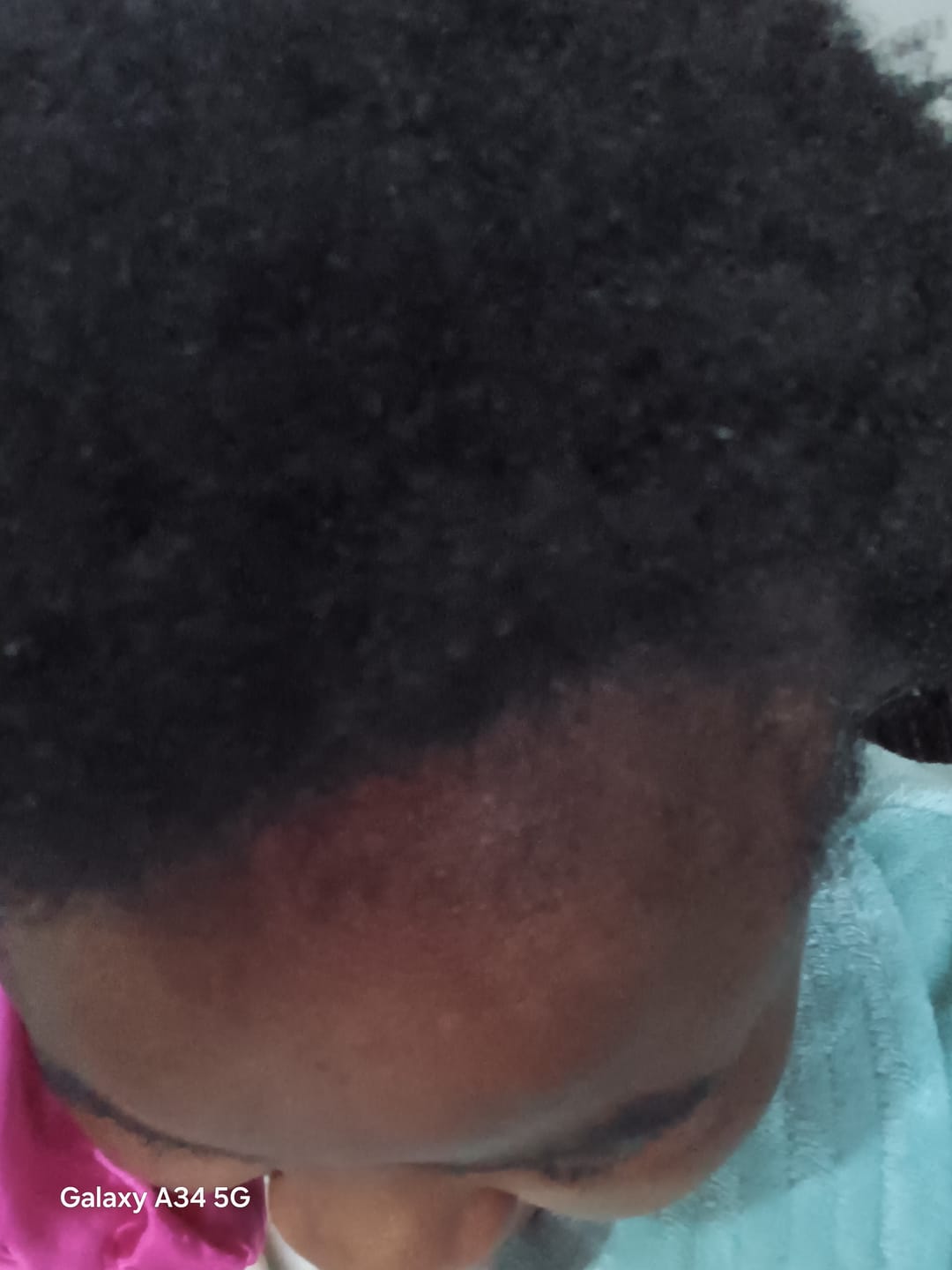 Customer photo review of Minoxidil 5% SOLUTION, 3 x 60ml pack