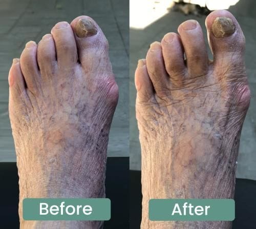 Customer photo review of VeroStep™ Bunion Fix