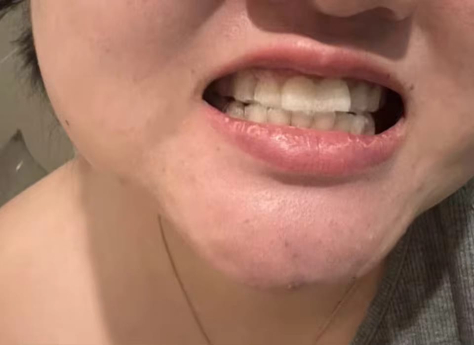 Customer photo review of PAP+ Powder - Whitening Booster