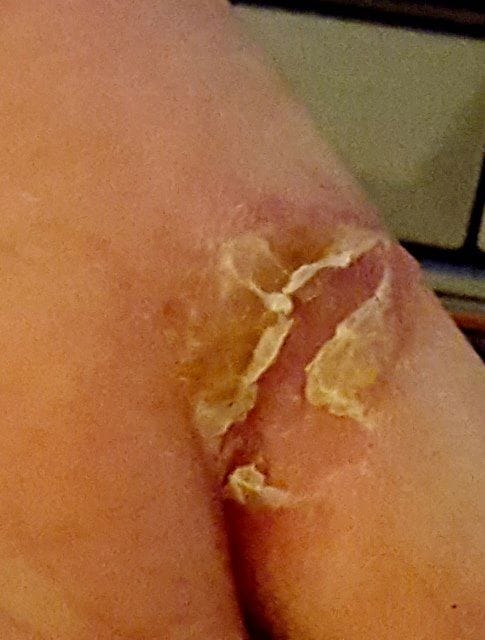 Customer photo review of Bioskin Zeoderm Skin Repair Moisturiser