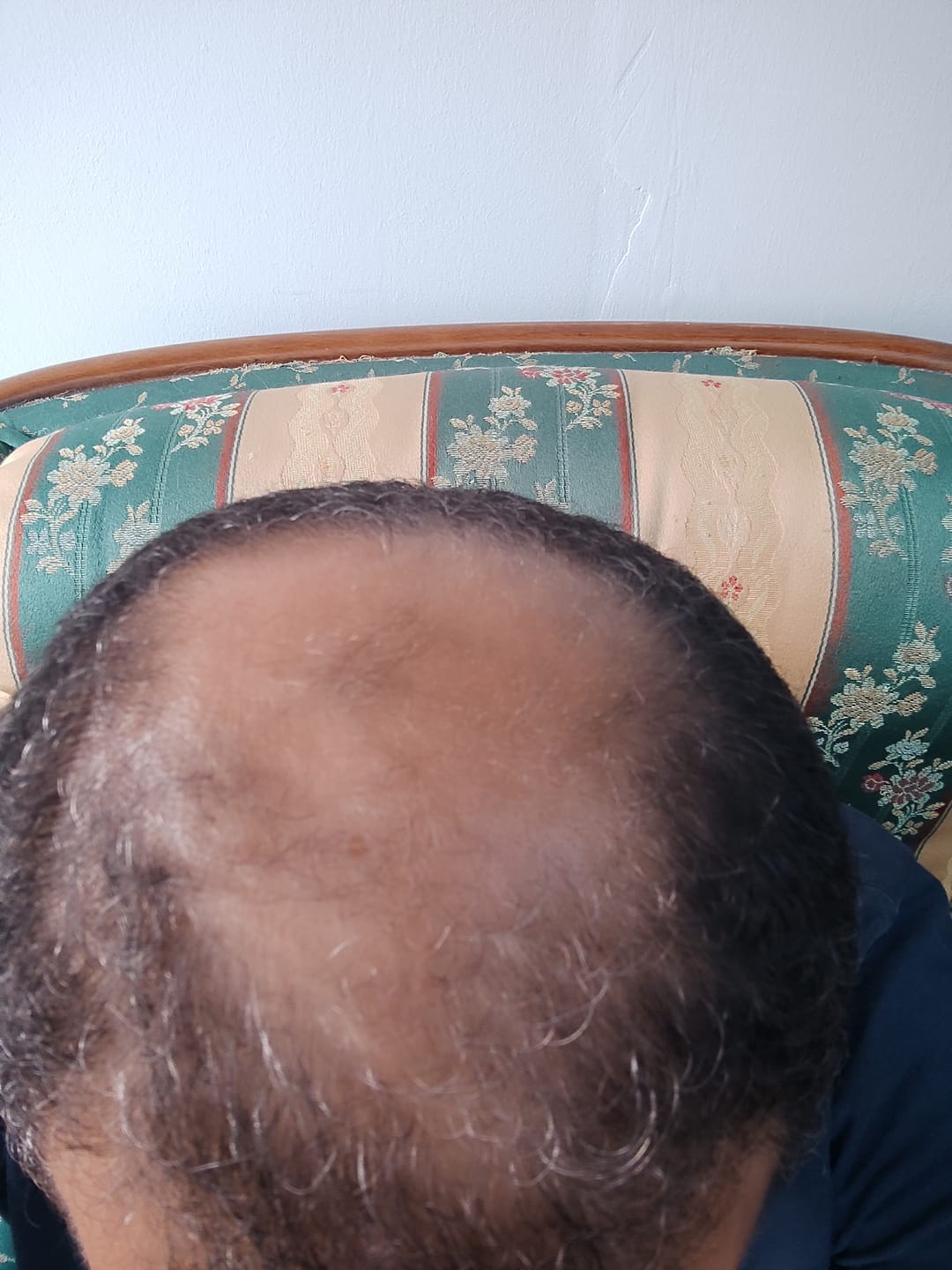 Customer photo review of DHT Blocker : Bloqueur de DHT Naturel | Saw Palmetto 320 mg | Max-Barber
