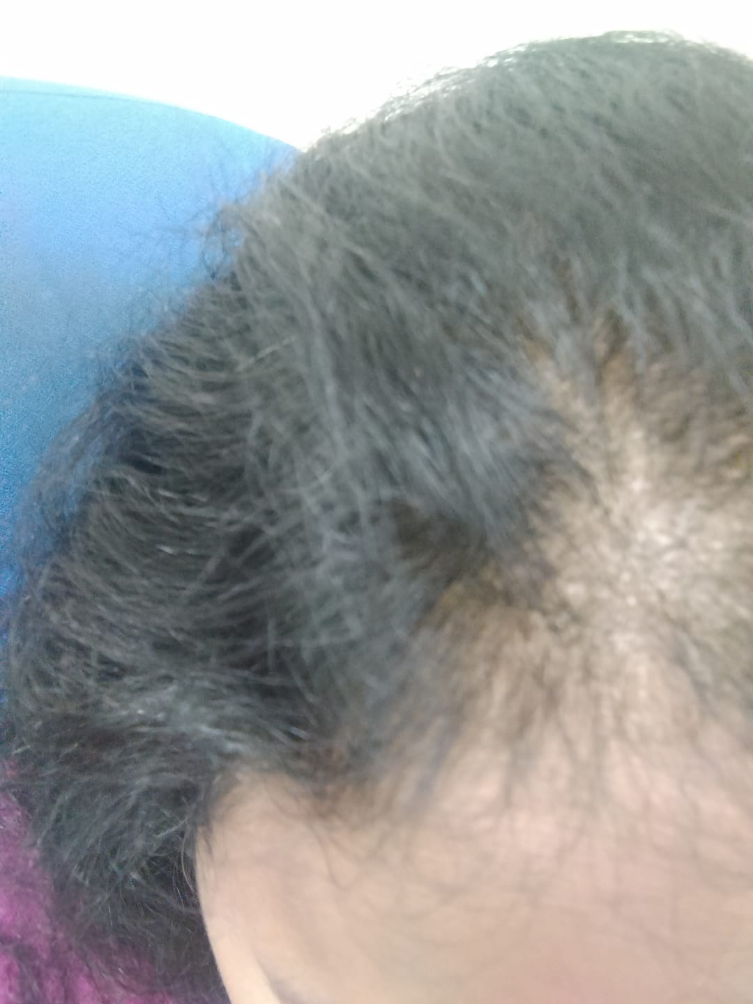 Customer photo review of Advance Hair Growth Serum 2.0 (30ml)
