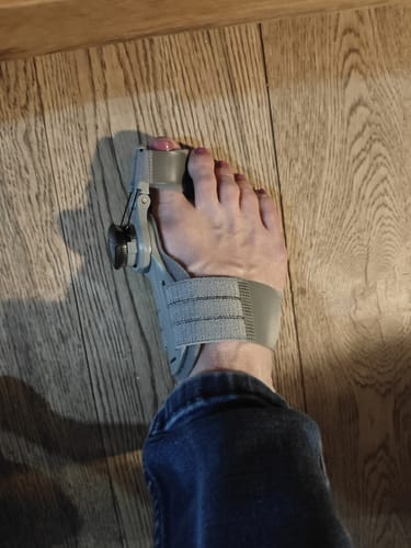 Customer photo review of VeroStep™ Bunion Fix