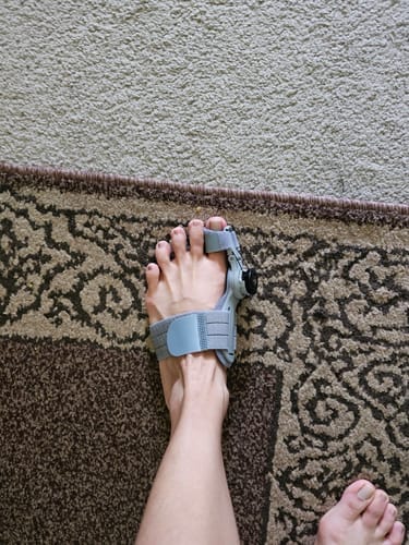 Customer photo review of VeroStep™ Bunion Fix
