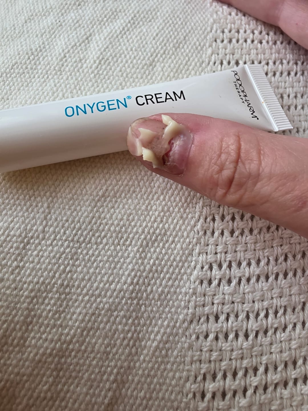 Customer photo review of Podopharm Therapy Onygen Cream with Colostrum for Damaged and Weakened Nails 20ml