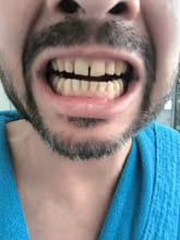 Customer photo review of PAP+ Powder - Whitening Booster