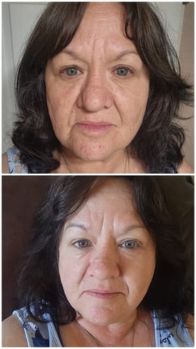 Reviewer's before-and-after photos show fewer fine lines and better skin tone after using the Seranova Micro Infusion System.