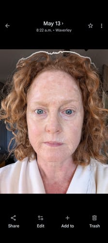 Reviewer's face after the first treatment with the Seranova Micro Infusion System, showing visible lines.