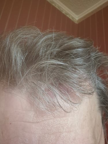 Vásárló közeli képe a hajas fejbőrről a Sebovia Essence sampon használata utáni állapotról.
