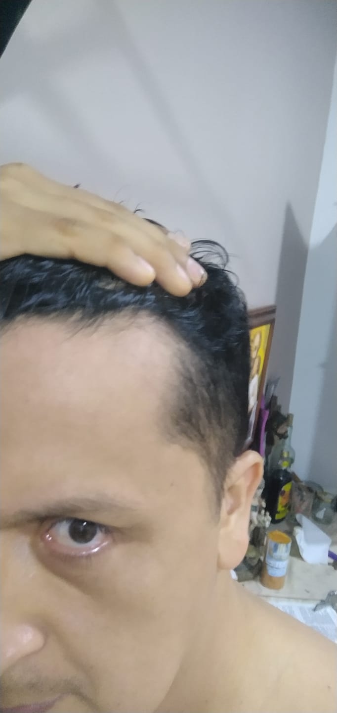 Customer photo review of Tónico Capilar de Romero  · Crecimiento y Anticaída