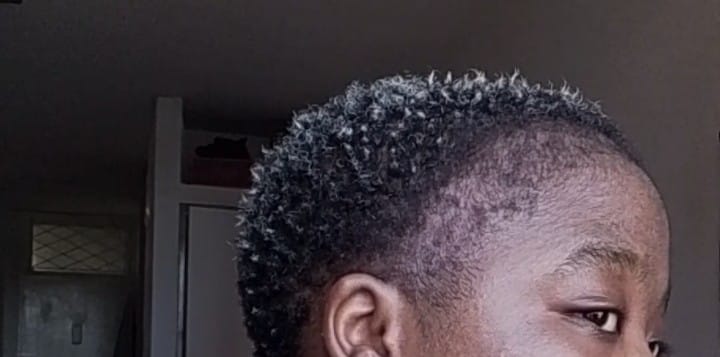 Customer photo review of Minoxidil 5% SOLUTION, 3 x 60ml pack
