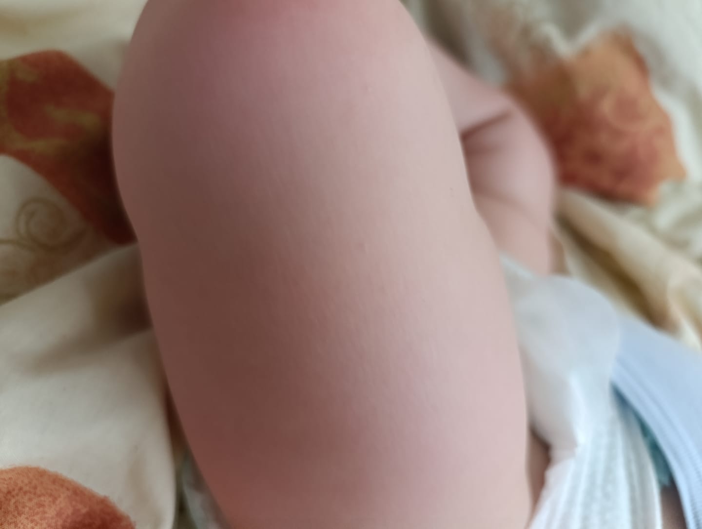 Customer photo review of Bioskin Junior Outbreak Rescue Cream