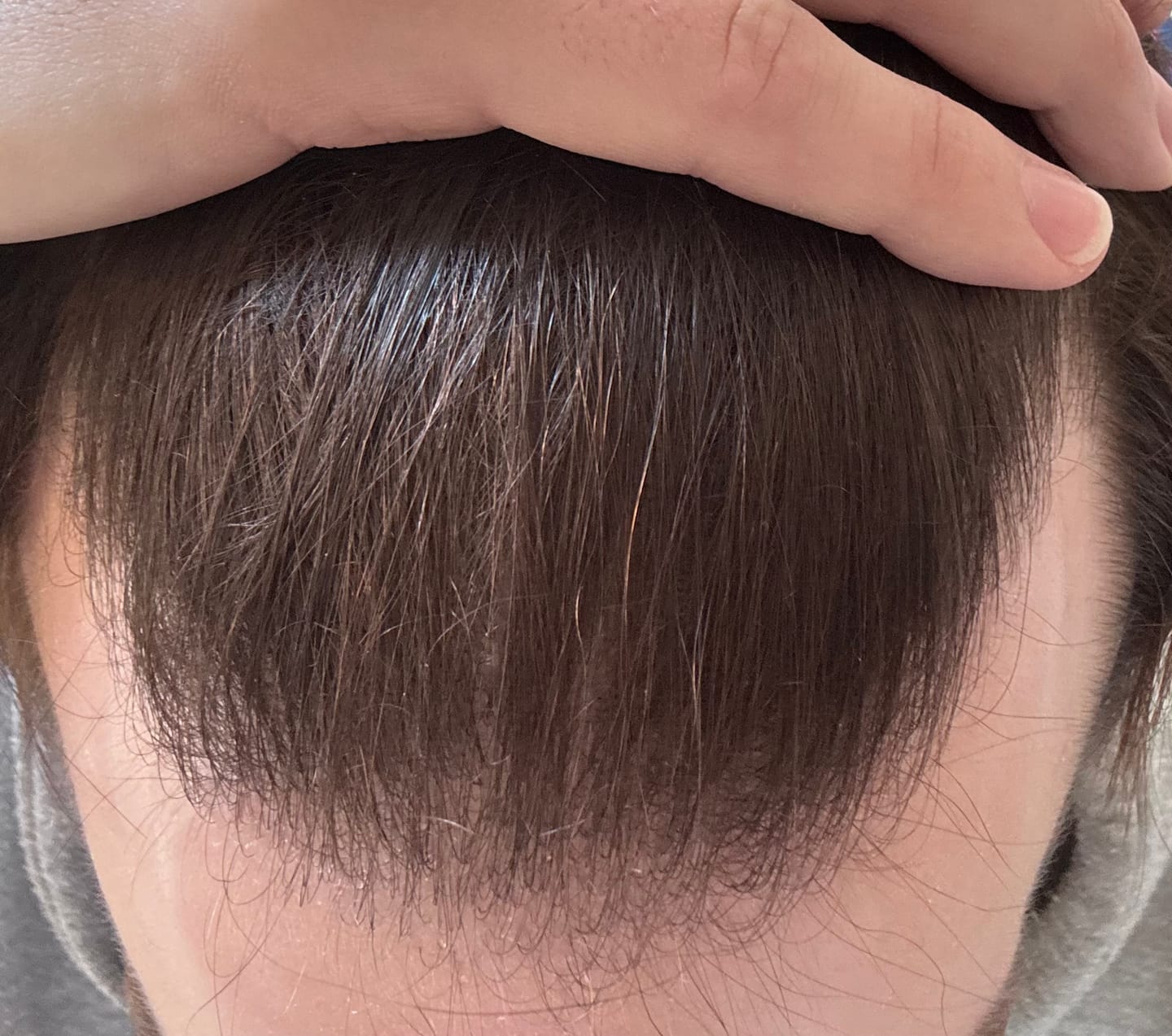 Customer photo review of Minoxidil 5% SOLUTION, 3 x 60ml pack