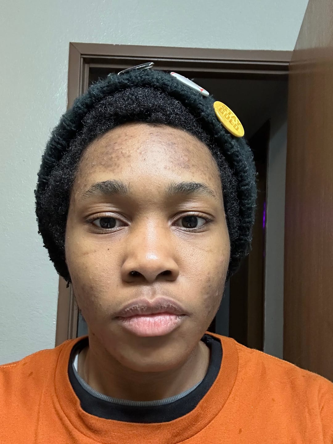 Customer photo review of Sea No Breakouts Anti-Breakout Solution Collection