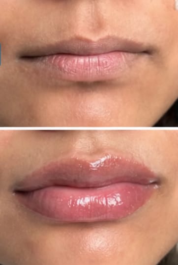 Customer photo review of Collagen Lip Plumper | 100% Natural & Vegan