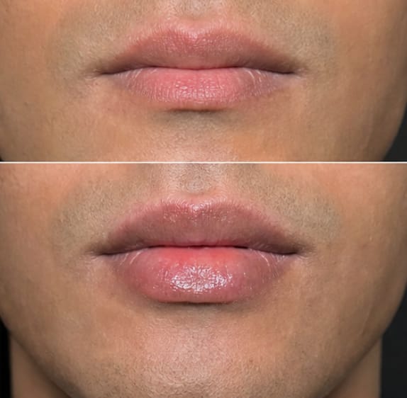 Customer photo review of Collagen Lip Plumper | 100% Natural & Vegan