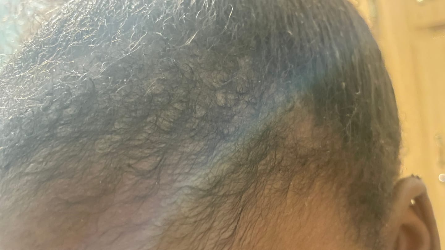 Customer photo review of Minoxidil REGULAR (2%) strength SOLUTION, 3month supply