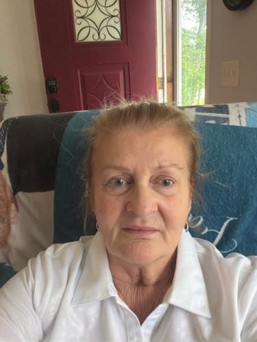 Reviewer showing their face after one month of using the Seranova Microneedling Infusion System.