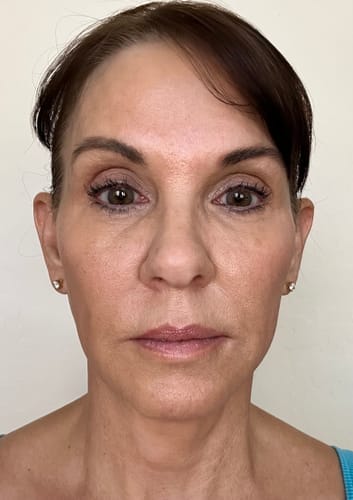 Customer photo review of Nutriskin LED Face Mask - Red Light Therapy for Wrinkles + FREE Neck Mask ($169 Value)
