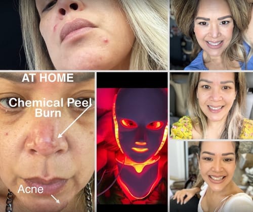 Customer photo review of Nutriskin LED Face Mask - Red Light Therapy for Wrinkles + FREE Neck Mask ($169 Value)