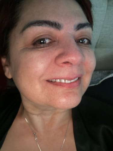 Customer photo review of Nutriskin LED Face Mask - Red Light Therapy for Wrinkles + FREE Neck Mask ($169 Value)