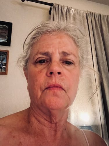 Customer photo review of Nutriskin LED Face Mask - Red Light Therapy for Wrinkles + FREE Neck Mask ($169 Value)