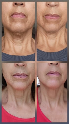 Reviewer's before and after comparison showing a firmer neck and jawline after using the Seranova Micro Infusion System.