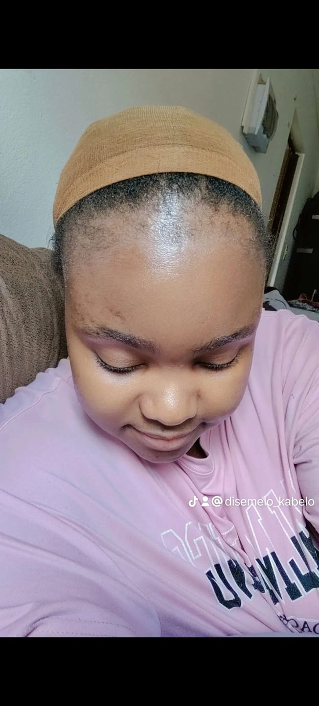 Customer photo review of Minoxidil 5% SOLUTION, 3 x 60ml pack