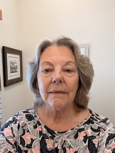 Customer's face after using the Seranova Micro Infusion System, showing smoother and more plump skin.