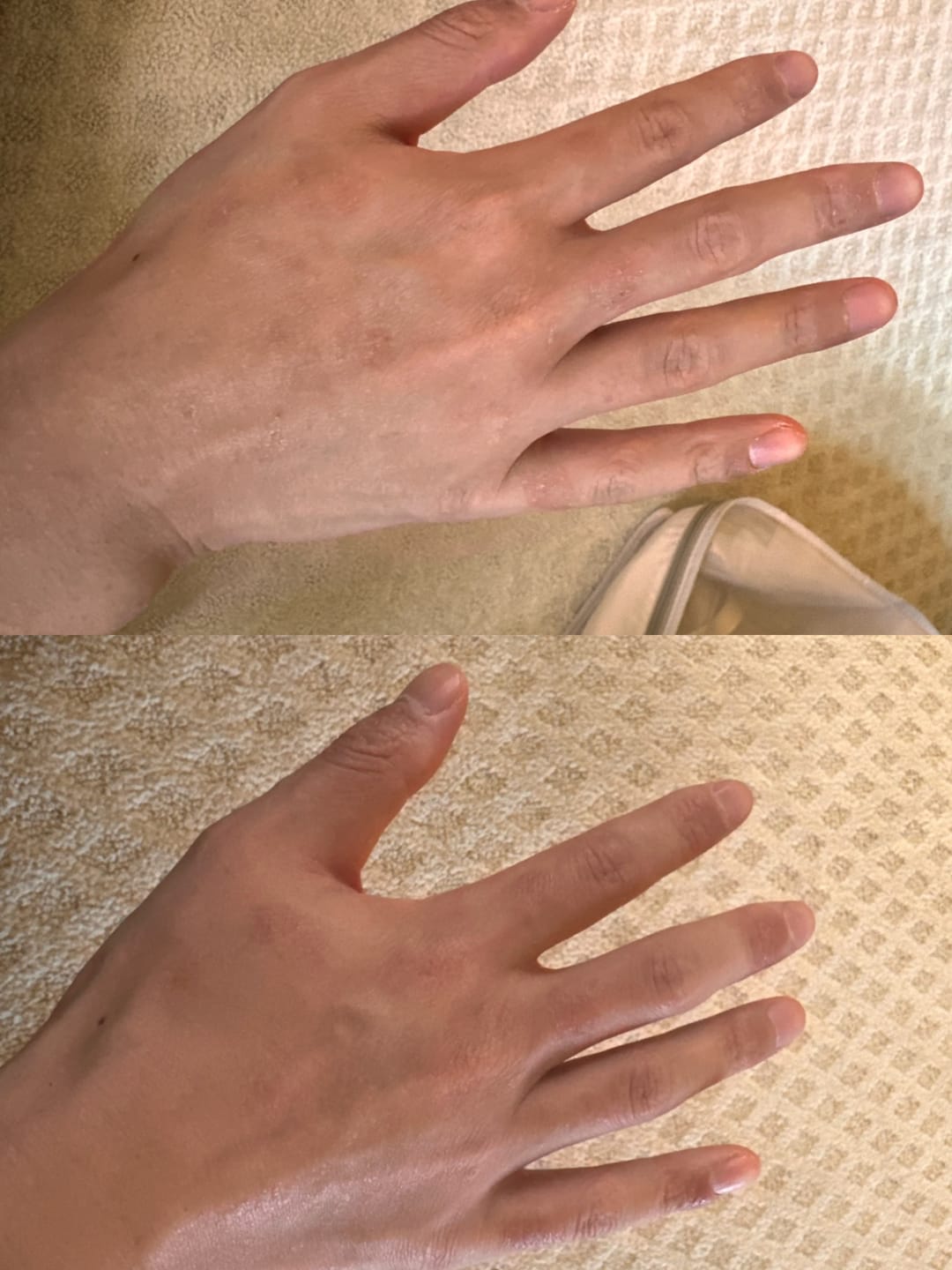 Customer photo review of Eczema Scratch Mitten