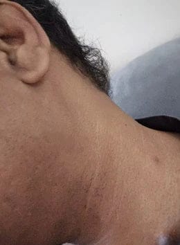 Customer photo review of Kit Anti-Acrochordons Vantyx