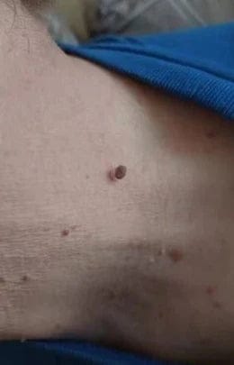 Customer photo review of Kit Anti-Acrochordons Vantyx