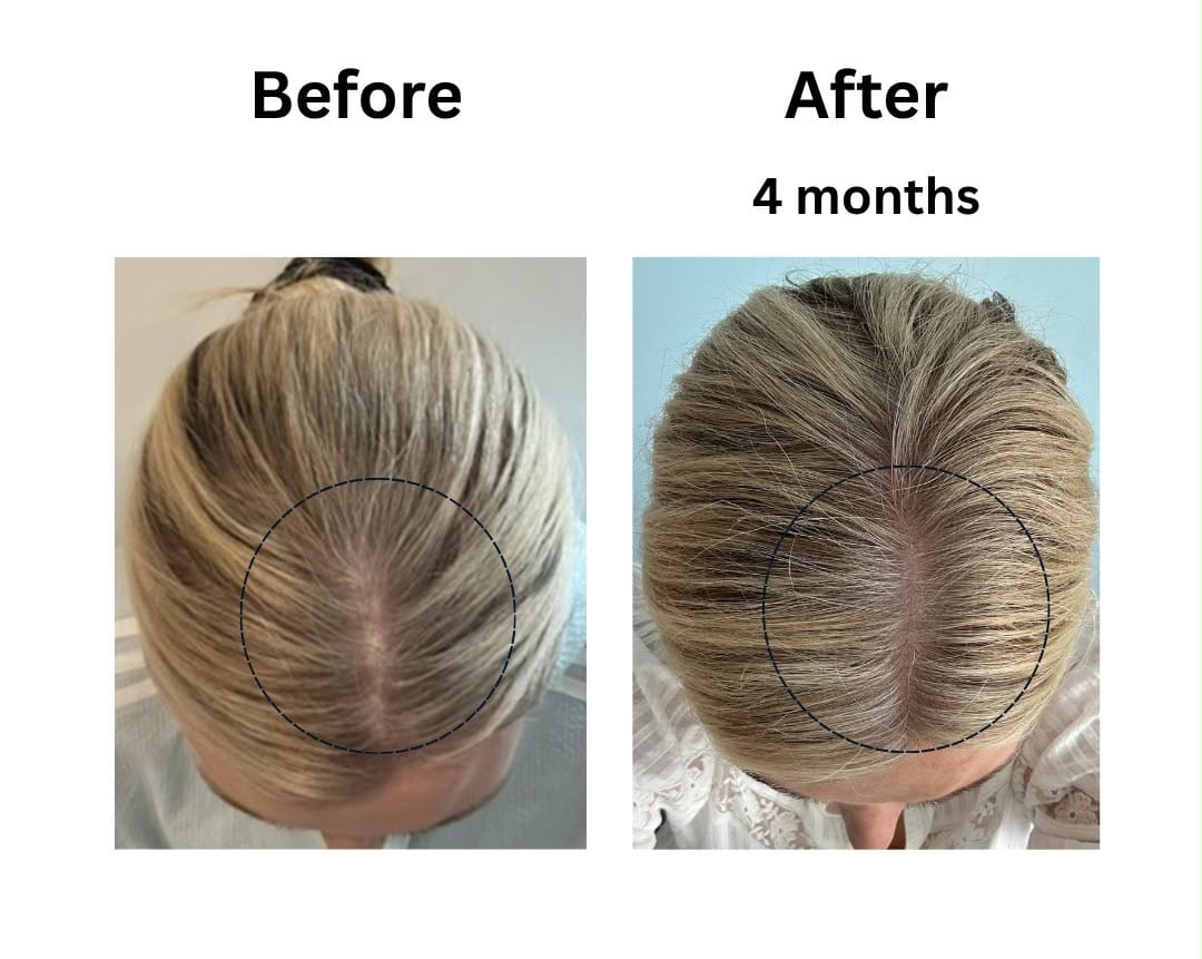 Customer photo review of LIVDOR Laser Hair Growth Cap for Thicker, Fuller Hair