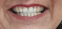 Customer photo review of PAP+ Powder - Whitening Booster