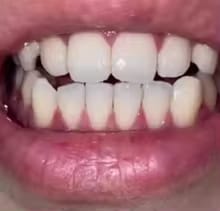 Customer photo review of PAP+ Powder - Whitening Booster