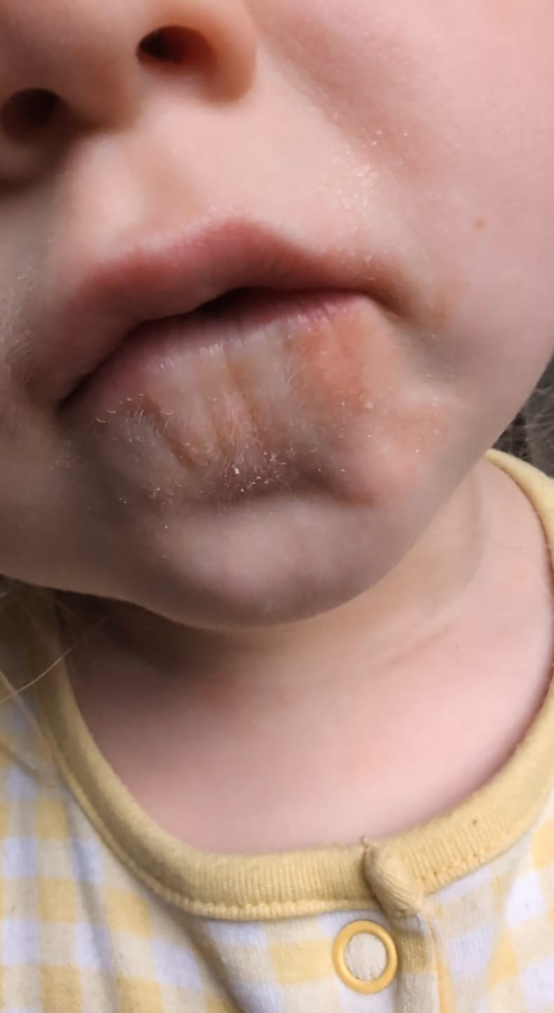 Customer photo review of Calm Skin-Relief Kit