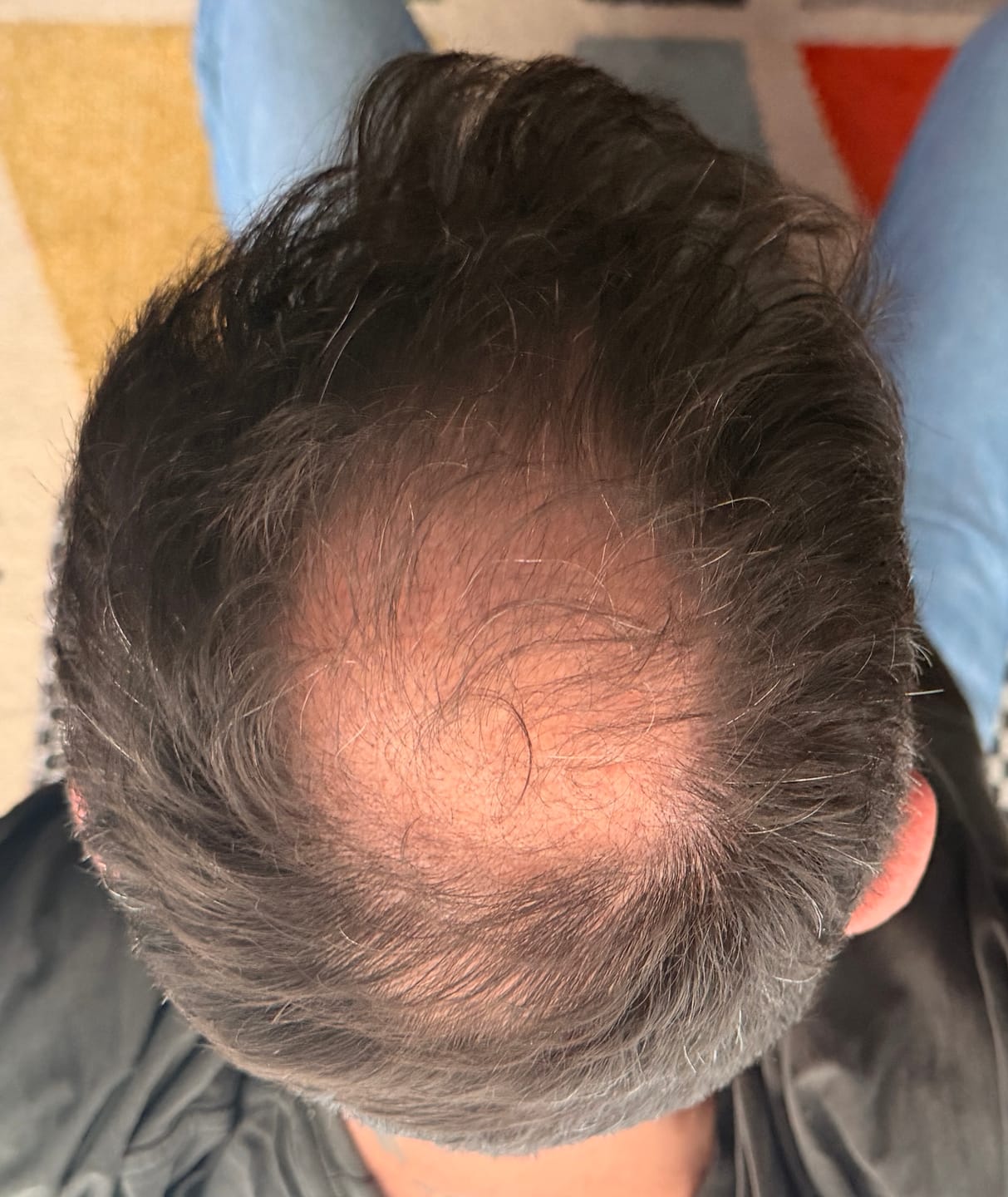 Customer photo review of SÉRUM CAPILLAIRE MULTI ACTIF BIO-DENSYL®