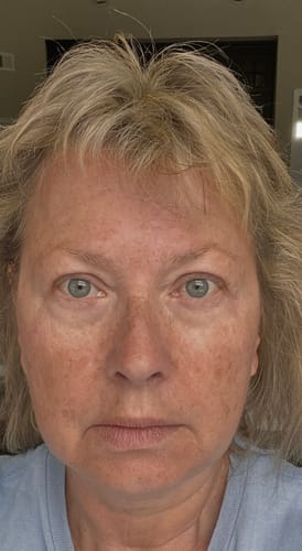 A close-up of the reviewer's face, showing her skin texture before using The Micro Infusion System.